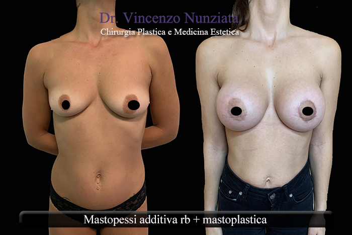 Asimmetrie mammarie prima e dopo – Paziente 9 – Dr. Vincenzo Nunziata, chirurgo plastico – foto 3