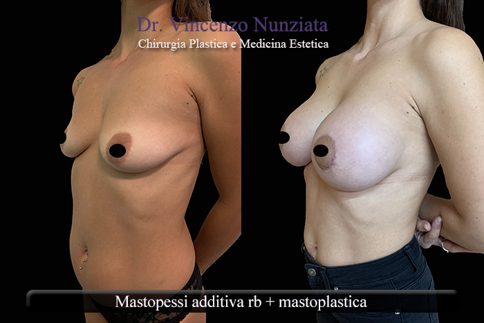 Asimmetrie mammarie prima e dopo – Paziente 9 – Dr. Vincenzo Nunziata, chirurgo plastico – foto 2