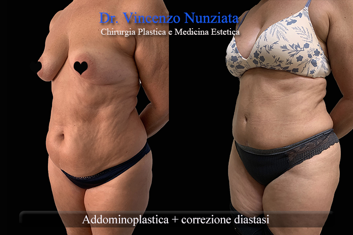 Addominoplastica prima e dopo – Paziente 24 – Dr. Vincenzo Nunziata, chirurgo plastico – foto 3
