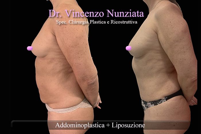 Addominoplastica prima e dopo – Paziente 25 – Dr. Vincenzo Nunziata, chirurgo plastico – foto 3
