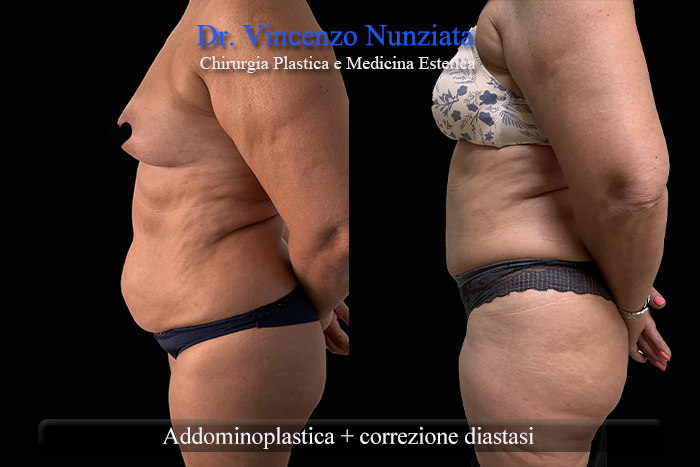 Addominoplastica prima e dopo – Paziente 24 – Dr. Vincenzo Nunziata, chirurgo plastico – foto 2