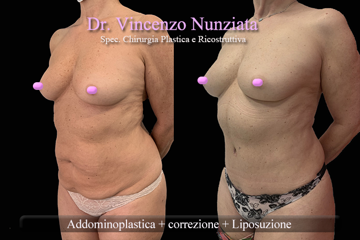 Addominoplastica prima e dopo – Paziente 25 – Dr. Vincenzo Nunziata, chirurgo plastico – foto 2