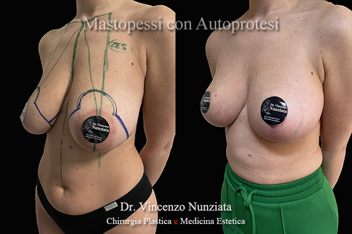 Mastopessi prima e dopo – Paziente 10 – Dr. Vincenzo Nunziata, chirurgo plastico – foto 2