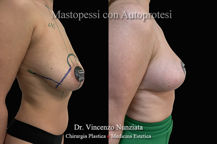 Mastopessi prima e dopo – Paziente 10 – Dr. Vincenzo Nunziata, chirurgo plastico – foto 4