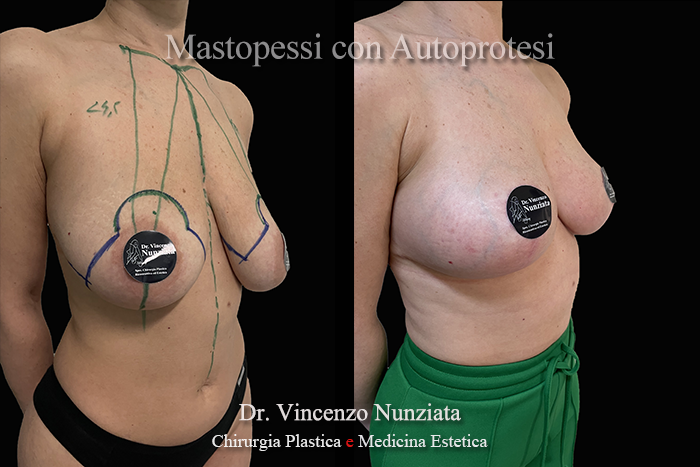 Mastopessi prima e dopo – Paziente 10 – Dr. Vincenzo Nunziata, chirurgo plastico – foto 3