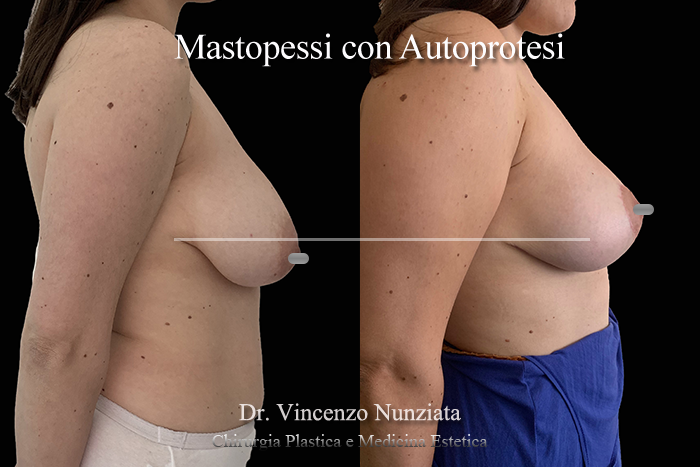 Mastopessi prima e dopo – Paziente 9 – Dr. Vincenzo Nunziata, chirurgo plastico – foto 3
