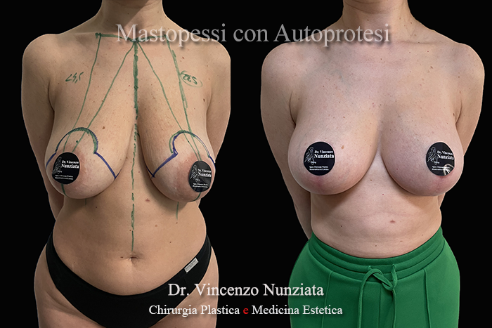 Mastopessi prima e dopo – Paziente 10 – Dr. Vincenzo Nunziata, chirurgo plastico – foto 1