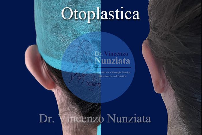 Otoplastica prima e dopo – Paziente 11 – Dr. Vincenzo Nunziata, chirurgo plastico – foto 3