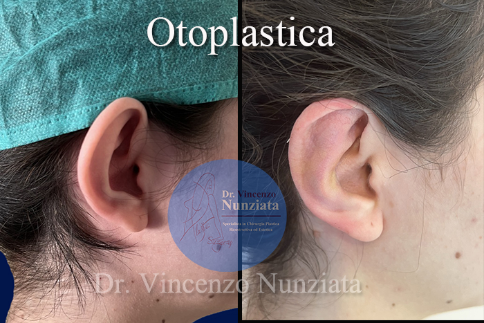 Otoplastica prima e dopo – Paziente 11 – Dr. Vincenzo Nunziata, chirurgo plastico – foto 2