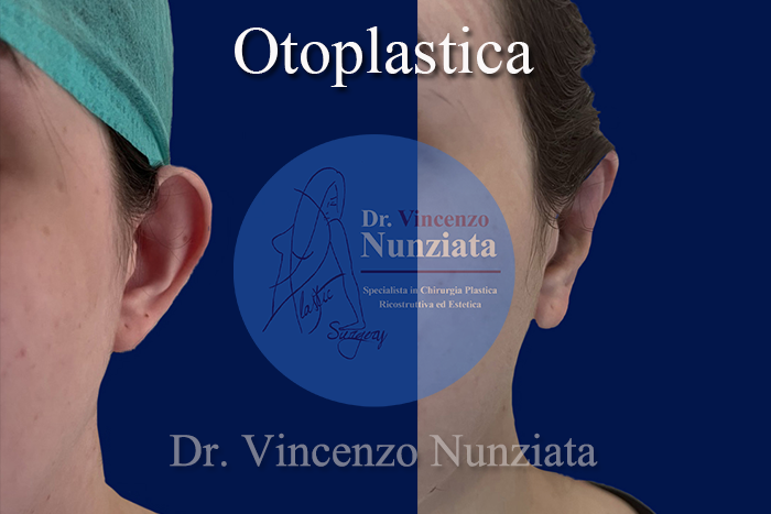 Otoplastica prima e dopo – Paziente 11 – Dr. Vincenzo Nunziata, chirurgo plastico