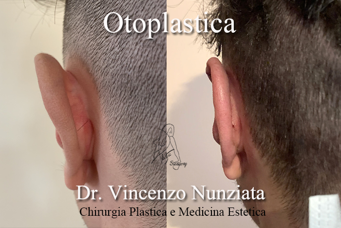 Otoplastica prima e dopo – Paziente 12 – Dr. Vincenzo Nunziata, chirurgo plastico