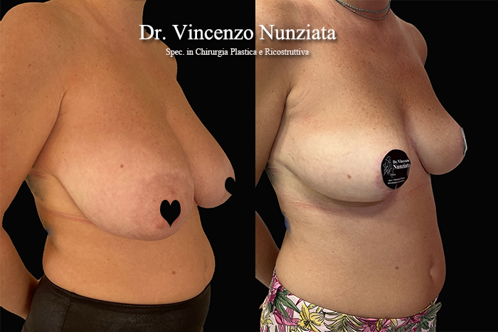 Mastopessi prima e dopo – Paziente 11 – Dr. Vincenzo Nunziata, chirurgo plastico – foto 3