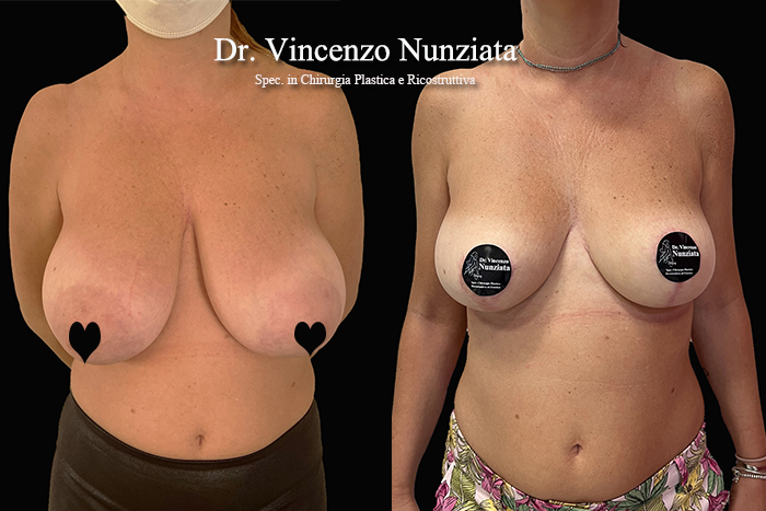 Mastopessi prima e dopo – Paziente 11 – Dr. Vincenzo Nunziata, chirurgo plastico – foto 1