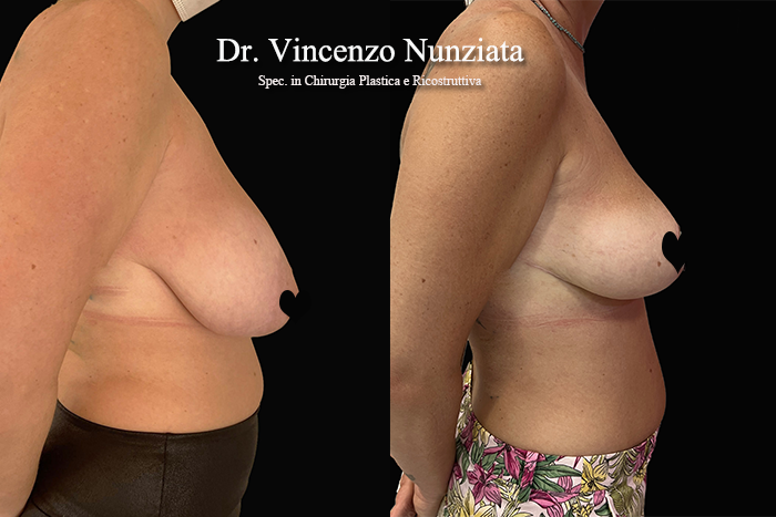 Mastopessi prima e dopo – Paziente 11 – Dr. Vincenzo Nunziata, chirurgo plastico – foto 2