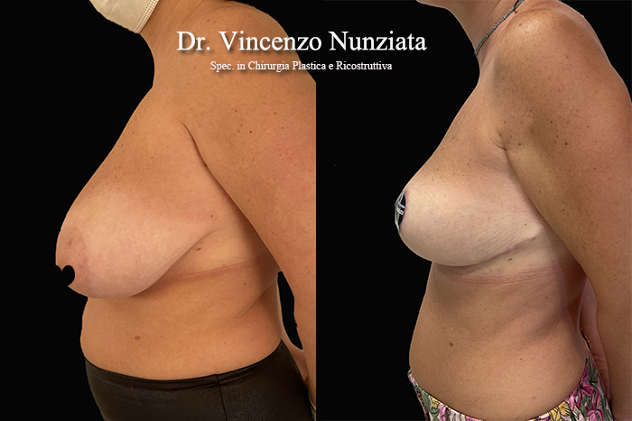 Mastopessi prima e dopo – Paziente 11 – Dr. Vincenzo Nunziata, chirurgo plastico – foto 4