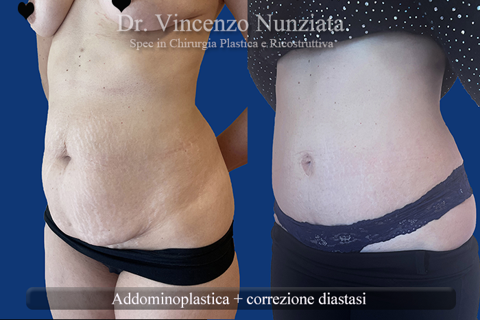 Addominoplastica prima e dopo – Paziente 26 – Dr. Vincenzo Nunziata, chirurgo plastico – foto 3