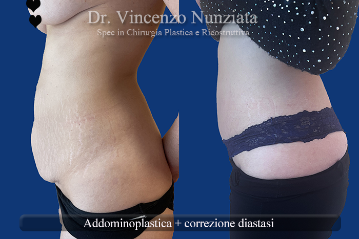 Addominoplastica prima e dopo – Paziente 26 – Dr. Vincenzo Nunziata, chirurgo plastico – foto 2