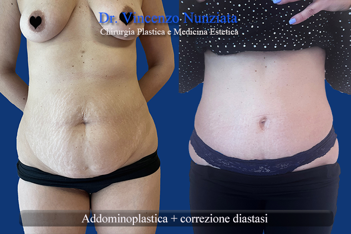 Addominoplastica prima e dopo – Paziente 26 – Dr. Vincenzo Nunziata, chirurgo plastico – foto 1