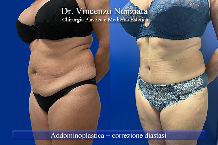 Addominoplastica prima e dopo – Paziente 27 – Dr. Vincenzo Nunziata, chirurgo plastico – foto 3