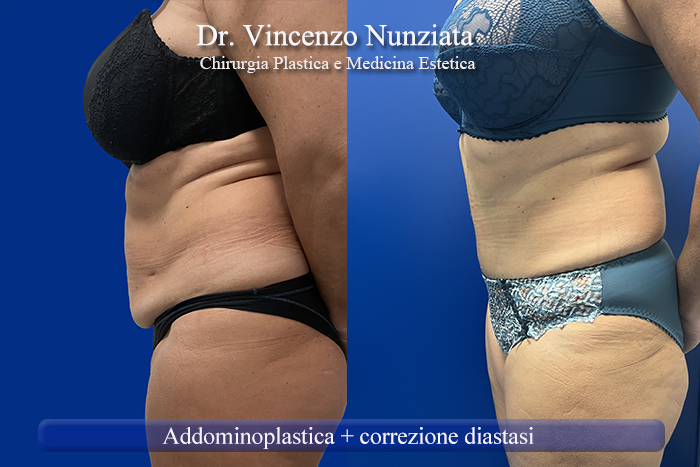 Addominoplastica prima e dopo – Paziente 27 – Dr. Vincenzo Nunziata, chirurgo plastico – foto 2