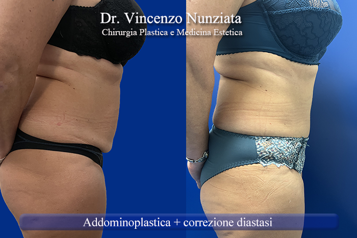 Addominoplastica prima e dopo – Paziente 27 – Dr. Vincenzo Nunziata, chirurgo plastico – foto 4