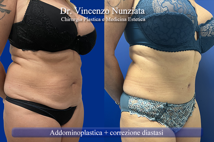 Addominoplastica prima e dopo – Paziente 27 – Dr. Vincenzo Nunziata, chirurgo plastico – foto 5