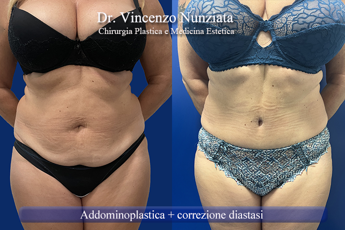 Addominoplastica prima e dopo – Paziente 27 – Dr. Vincenzo Nunziata, chirurgo plastico – foto 1