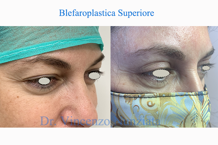 Blefaroplastica prima e dopo – Paziente 9 – Dr. Vincenzo Nunziata, chirurgo plastico – foto 3