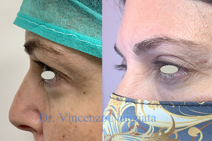 Blefaroplastica prima e dopo – Paziente 9 – Dr. Vincenzo Nunziata, chirurgo plastico – foto 2