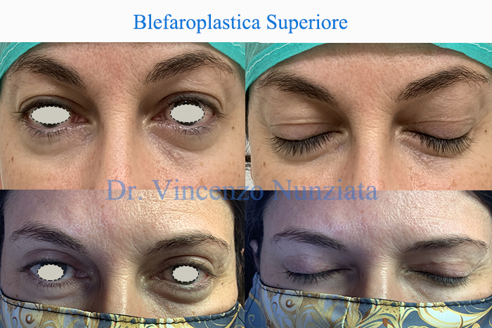 Blefaroplastica prima e dopo – Paziente 9 – Dr. Vincenzo Nunziata, chirurgo plastico – foto 1