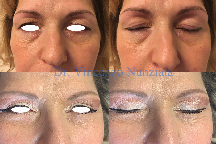 Blefaroplastica prima e dopo – Paziente 10 – Dr. Vincenzo Nunziata, chirurgo plastico – foto 1