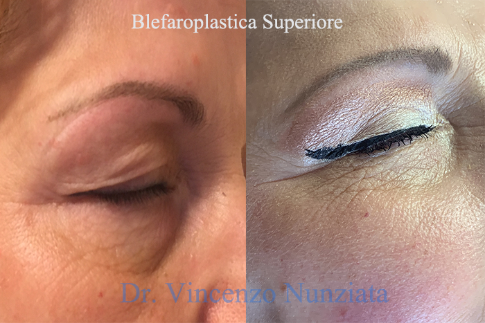 Blefaroplastica prima e dopo – Paziente 10 – Dr. Vincenzo Nunziata, chirurgo plastico – foto 2