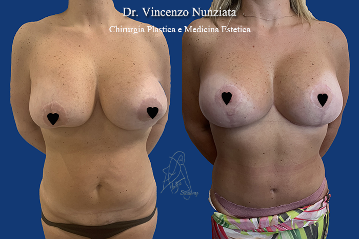 Revisioni mammarie prima e dopo – Paziente 7 – Dr. Vincenzo Nunziata, chirurgo plastico – foto 1