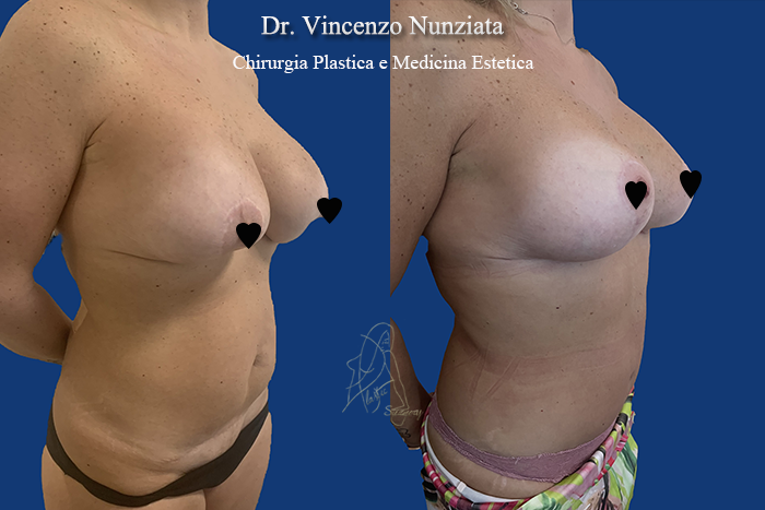 Revisioni mammarie prima e dopo – Paziente 7 – Dr. Vincenzo Nunziata, chirurgo plastico – foto 3