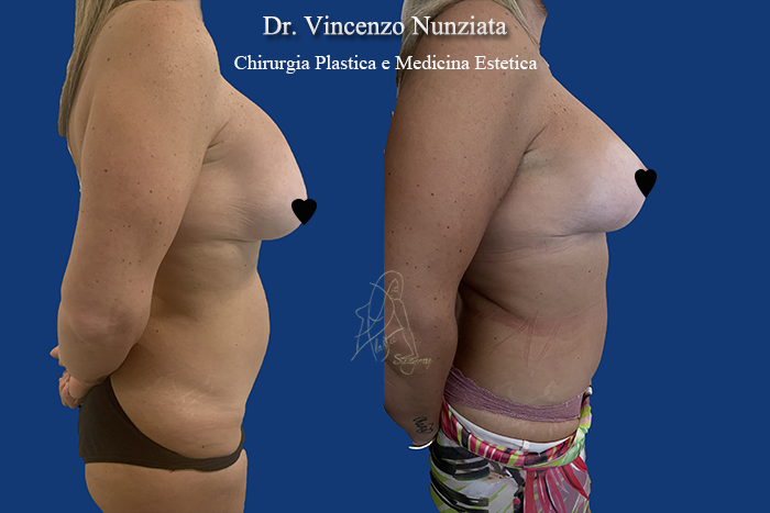 Revisioni mammarie prima e dopo – Paziente 7 – Dr. Vincenzo Nunziata, chirurgo plastico – foto 2