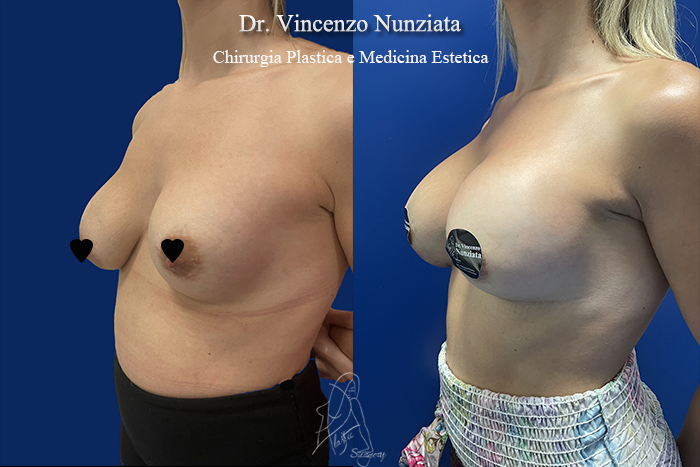 Revisioni mammarie prima e dopo – Paziente 10 – Dr. Vincenzo Nunziata, chirurgo plastico – foto 3