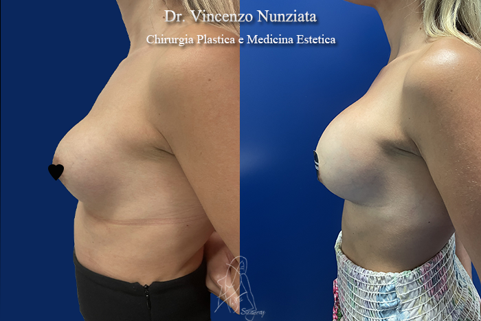 Revisioni mammarie prima e dopo – Paziente 10 – Dr. Vincenzo Nunziata, chirurgo plastico – foto 2