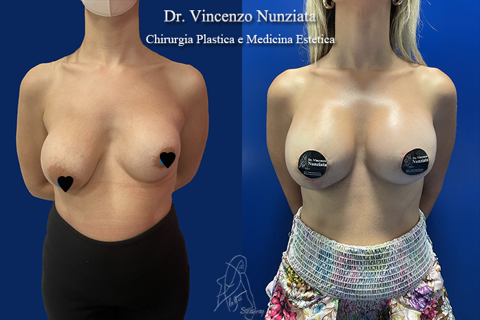 Revisioni mammarie prima e dopo – Paziente 10 – Dr. Vincenzo Nunziata, chirurgo plastico – foto 1