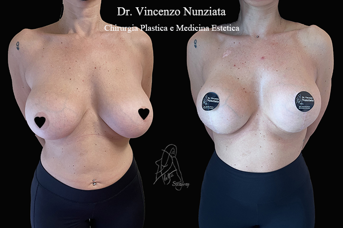 Revisioni mammarie prima e dopo – Paziente 9 – Dr. Vincenzo Nunziata, chirurgo plastico – foto 1