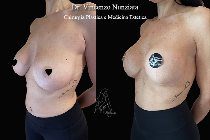 Revisioni mammarie prima e dopo – Paziente 9 – Dr. Vincenzo Nunziata, chirurgo plastico – foto 2