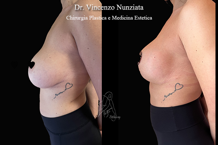 Revisioni mammarie prima e dopo – Paziente 9 – Dr. Vincenzo Nunziata, chirurgo plastico – foto 4
