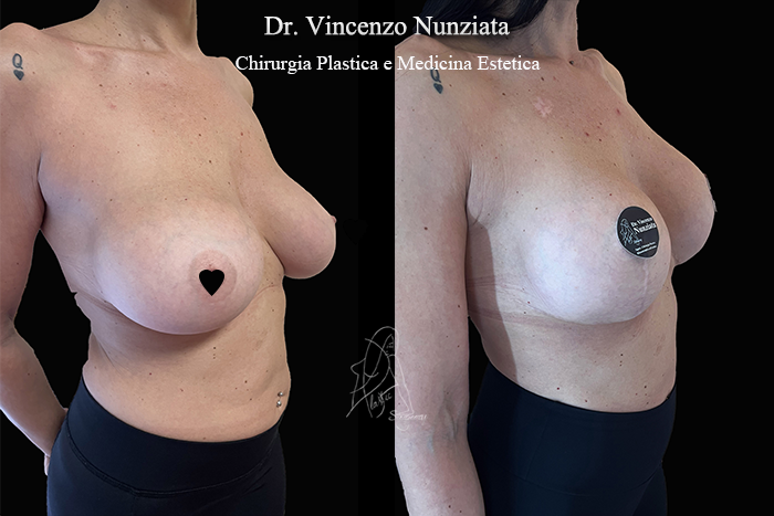 Revisioni mammarie prima e dopo – Paziente 9 – Dr. Vincenzo Nunziata, chirurgo plastico – foto 3