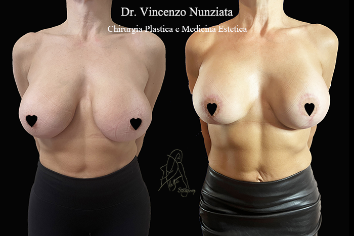 Revisioni mammarie prima e dopo – Paziente 8 – Dr. Vincenzo Nunziata, chirurgo plastico – foto 1
