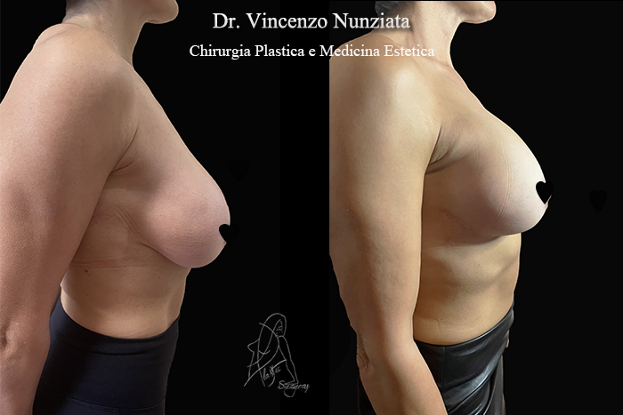 Revisioni mammarie prima e dopo – Paziente 8 – Dr. Vincenzo Nunziata, chirurgo plastico – foto 3