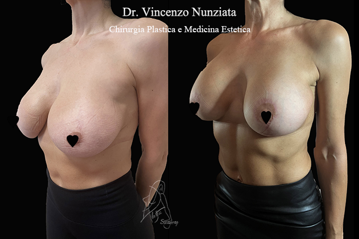 Revisioni mammarie prima e dopo – Paziente 8 – Dr. Vincenzo Nunziata, chirurgo plastico – foto 2