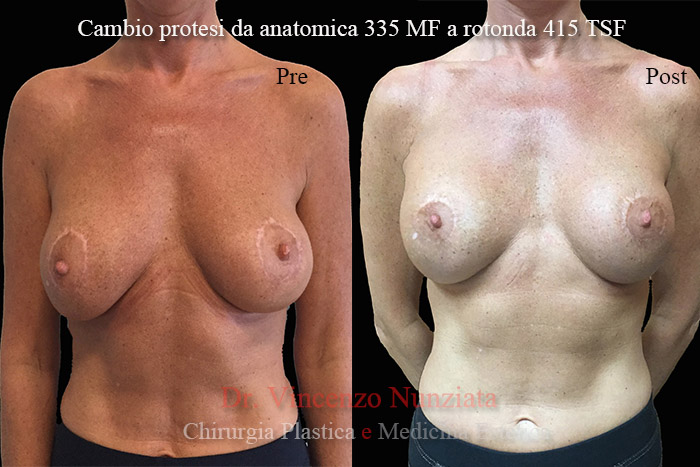 Revisioni mammarie prima e dopo – Paziente 6 – Dr. Vincenzo Nunziata, chirurgo plastico – foto 1
