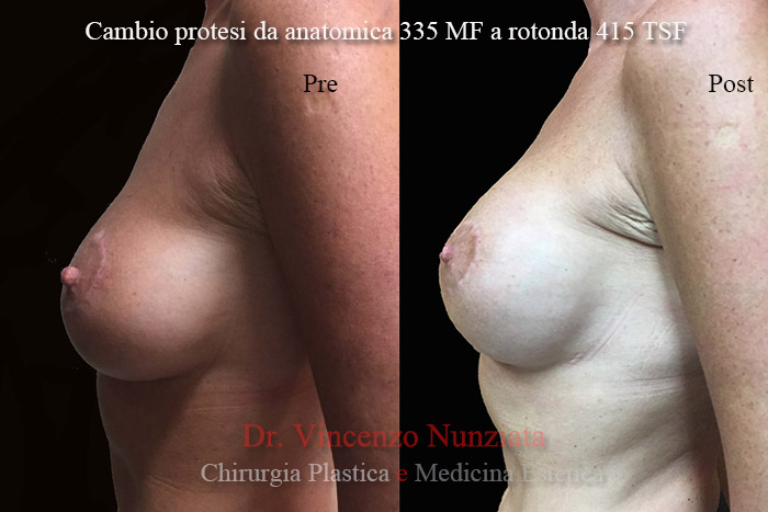 Revisioni mammarie prima e dopo – Paziente 6 – Dr. Vincenzo Nunziata, chirurgo plastico – foto 2