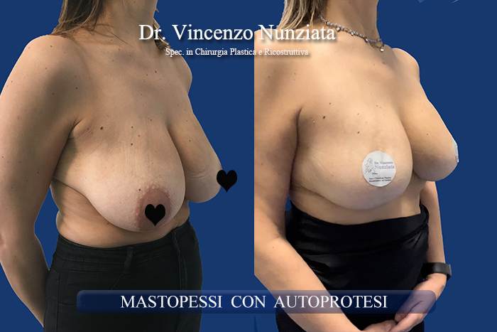 Mastopessi prima e dopo – Paziente 12 – Dr. Vincenzo Nunziata, chirurgo plastico – foto 2