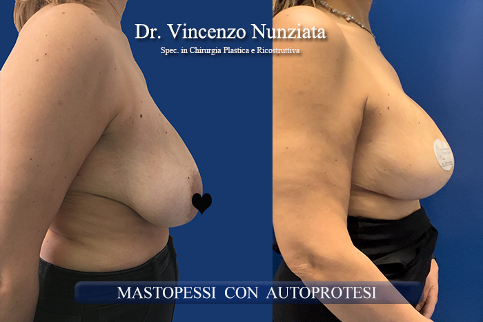 Mastopessi prima e dopo – Paziente 12 – Dr. Vincenzo Nunziata, chirurgo plastico – foto 4
