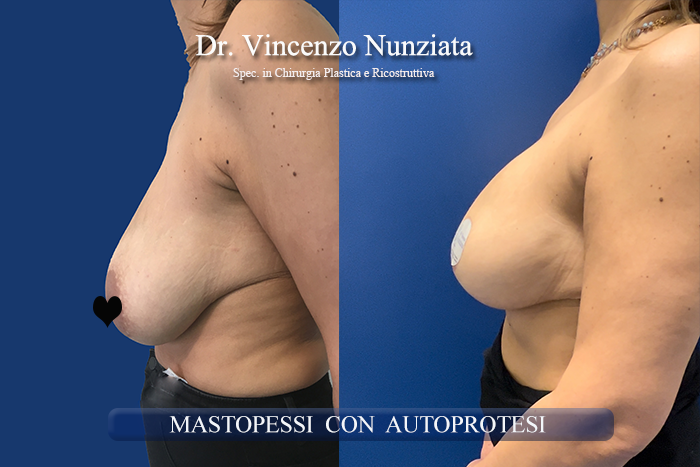 Mastopessi prima e dopo – Paziente 12 – Dr. Vincenzo Nunziata, chirurgo plastico – foto 3